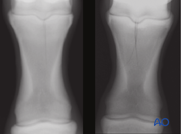 Simple sagittal configuration (left) and propagation in the mid-prosximal phalanx (right)