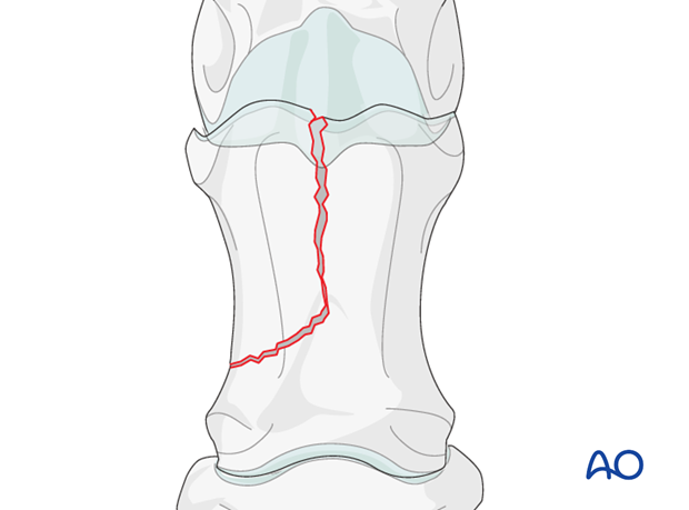Complete uniarticular sagittal fracture
