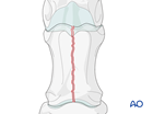proximal phalanx complete biarticular