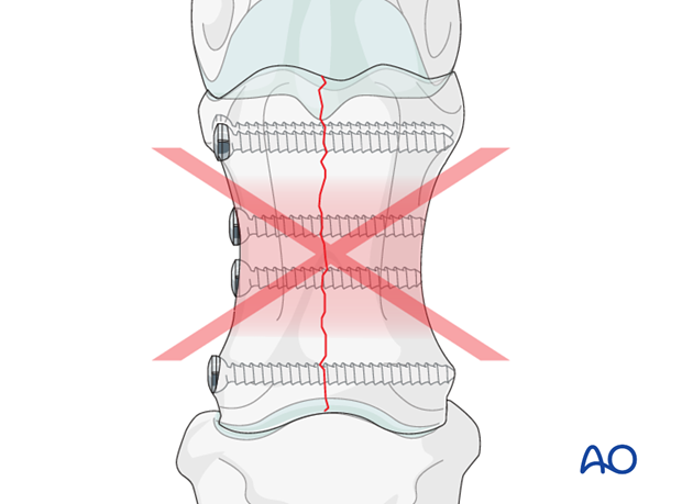 Central "waist" of the proximal phalanx