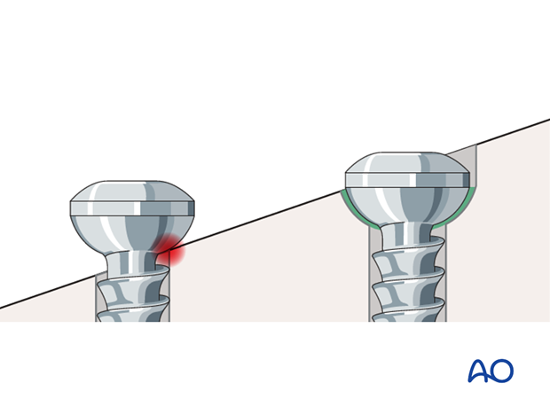 Pitfall: Countersinking in oblique bone surface