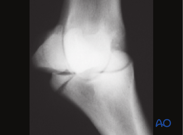 Radiographic example of plantar eminence fracture