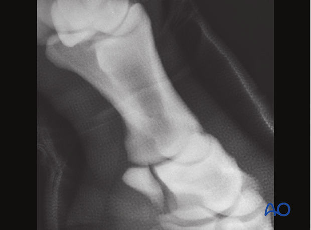 fractures and injuries of the middle phalanx