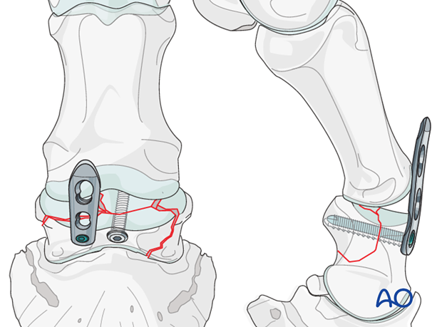 Usually, the second eminence fracture ...