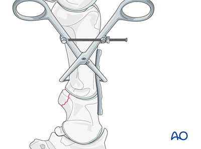 Fixation with a DCP or LC-DCP