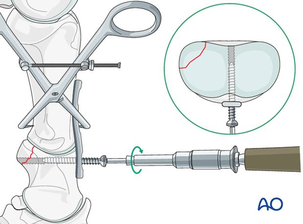 The thread hole for the first 5.5mm cortex screw is drilled just distal ...