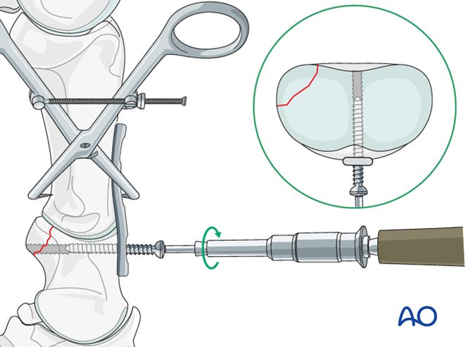 Fixation with a DCP or LC-DCP