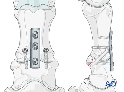 Fixation with a DCP or LC-DCP