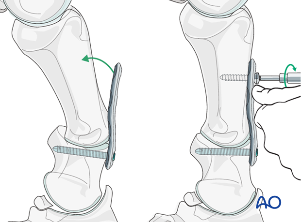 In early mild cases, where the palmar/plantar support structures are not markedly contracted...