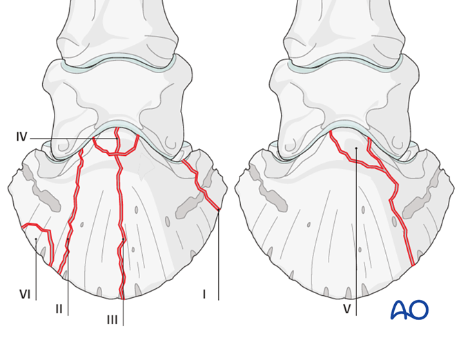 Extensor Process Distal phalanx: Extensor process fractures
