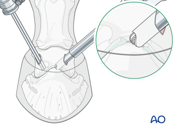 Distal interphalangeal joint arthrodesis