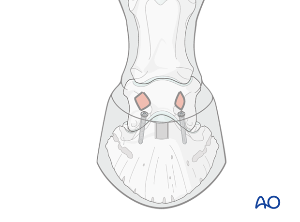 Distal interphalangeal joint arthrodesis