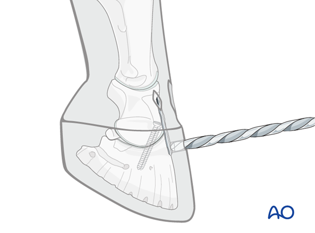 Distal interphalangeal joint arthrodesis
