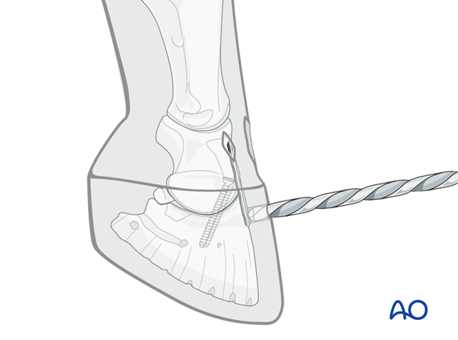 Arthrodesis with plate and screws for Distal interphalangeal joint