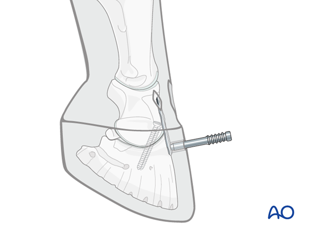 Distal interphalangeal joint arthrodesis