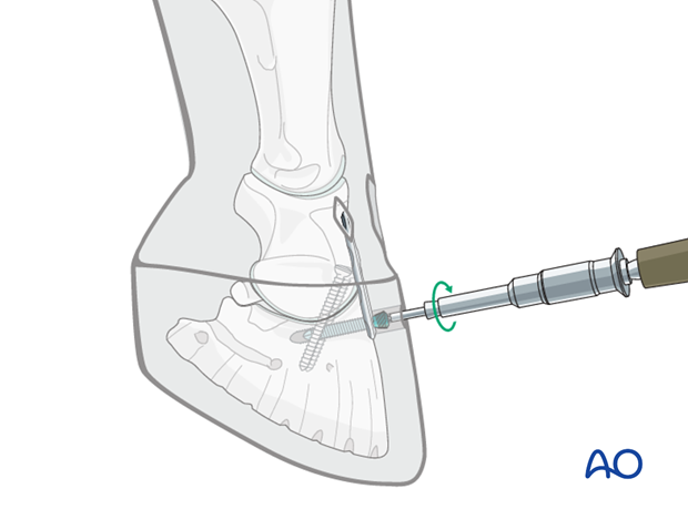 Distal interphalangeal joint arthrodesis