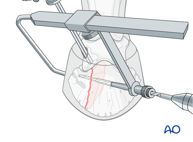 Abaxial articular fracture of the distal phalanx - screw fixation