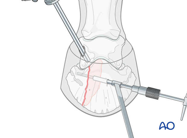 Abaxial articular fracture of the distal phalanx - screw fixation