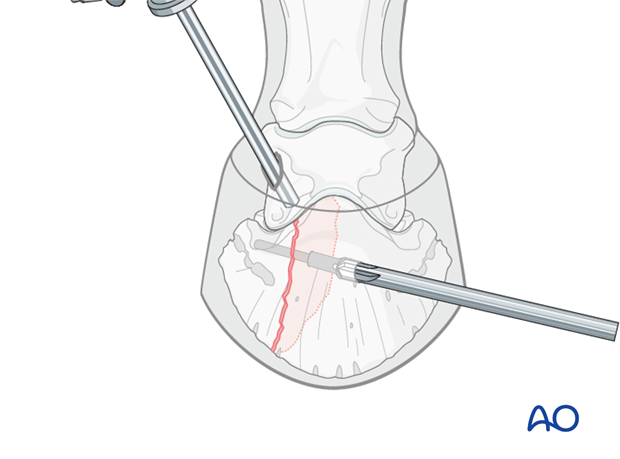 Abaxial articular fracture of the distal phalanx - screw fixation