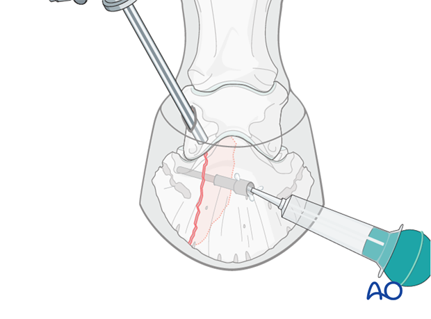 Abaxial articular fracture of the distal phalanx - screw fixation