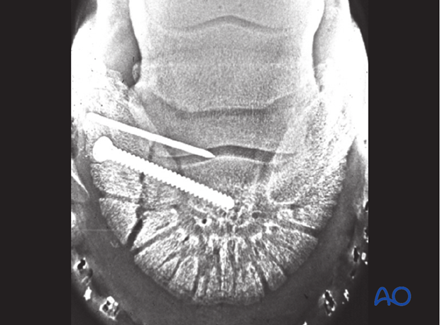 Abaxial articular fracture of the distal phalanx - screw fixation