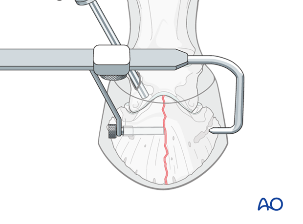 Sagittal fracture of the distal phalanx - screw fixation