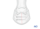 Sagittal fractures of the distal phalanx