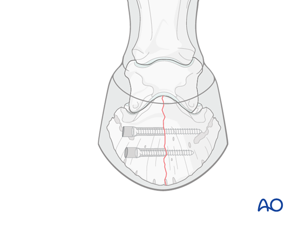 Sagittal fracture of the distal phalanx - screw fixation