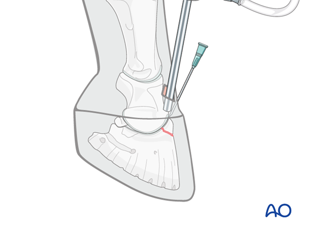 Extensor process fracture of the distal phalanx - screw fixation