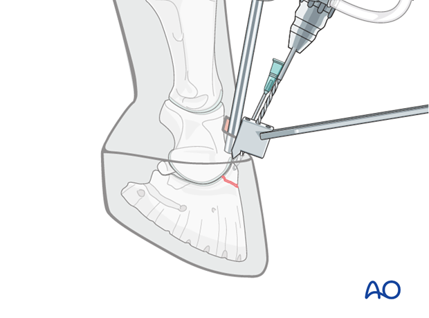 Extensor process fracture of the distal phalanx - screw fixation