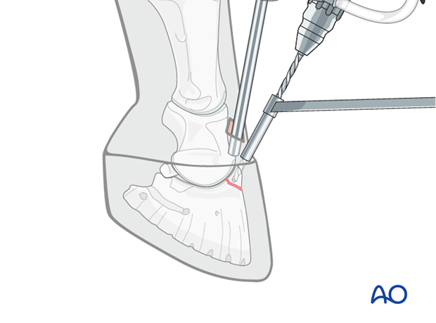 Extensor process fracture of the distal phalanx - screw fixation