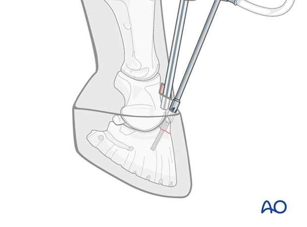 Extensor process fracture of the distal phalanx - screw fixation