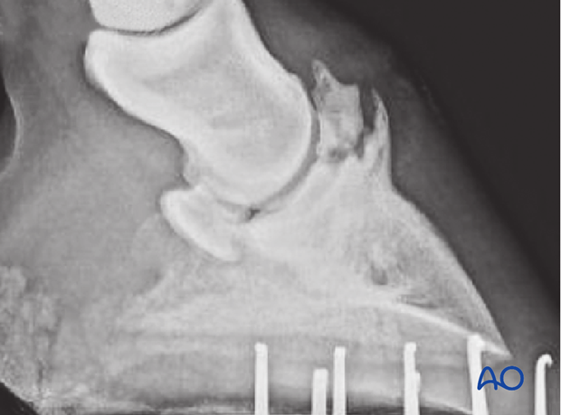 Extensor process fracture of the distal phalanx - fragment removal