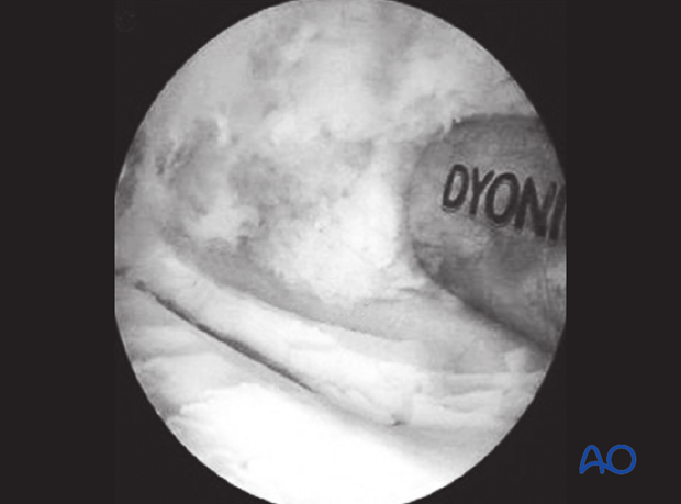 Extensor process fracture of the distal phalanx - fragment removal