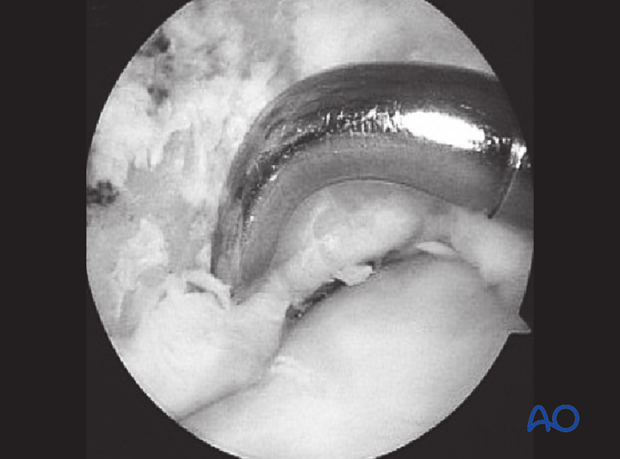 Extensor process fracture of the distal phalanx - fragment removal