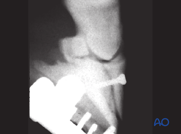 Extensor process fracture of the distal phalanx - rare fractures