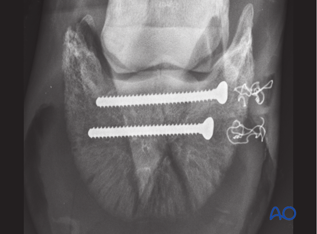 Multifragement fracture of the distal phalanx