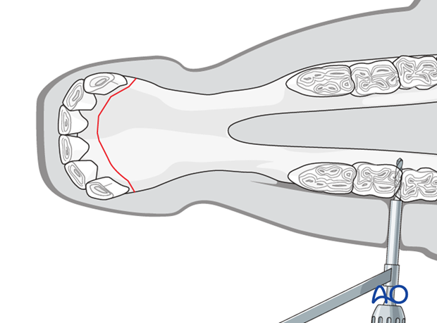 wire fixation