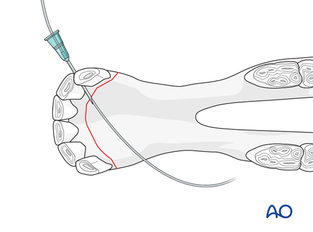 wire fixation