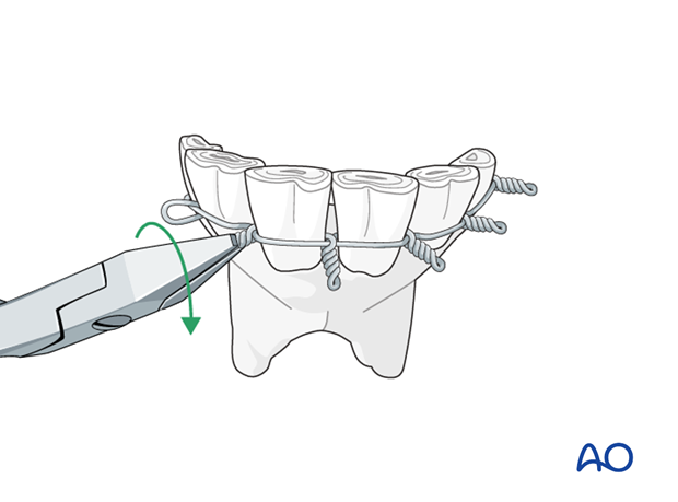 wire fixation