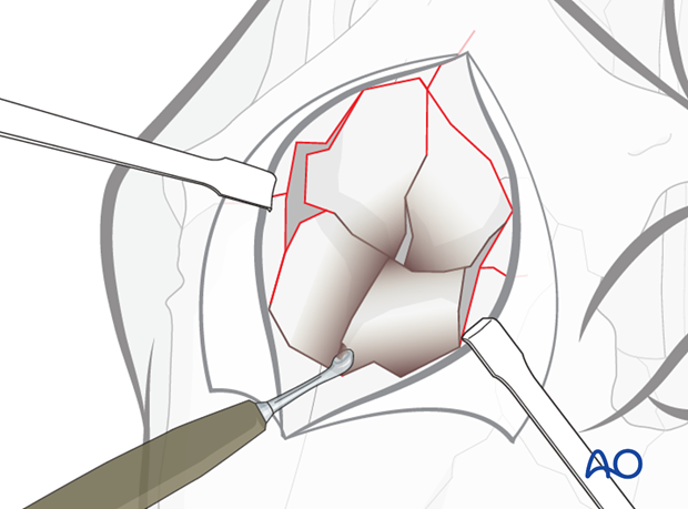 approach to frontalnasal bone