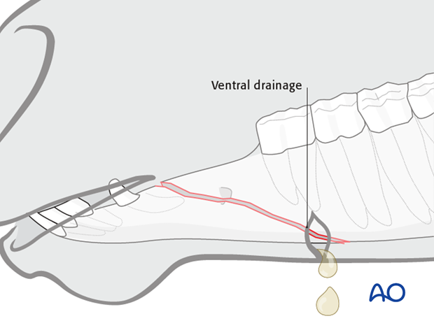 wire fixation