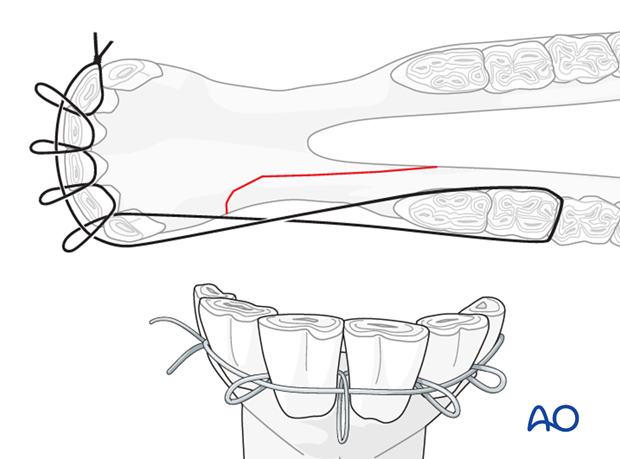 wire fixation