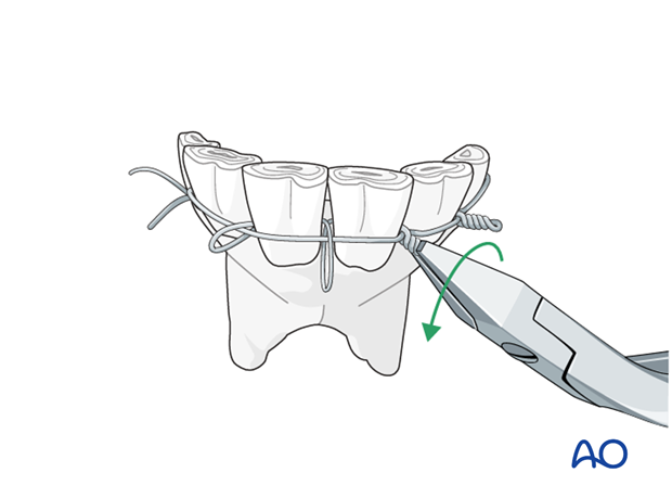 wire fixation