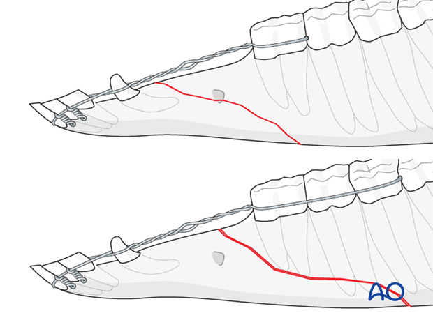 wire fixation