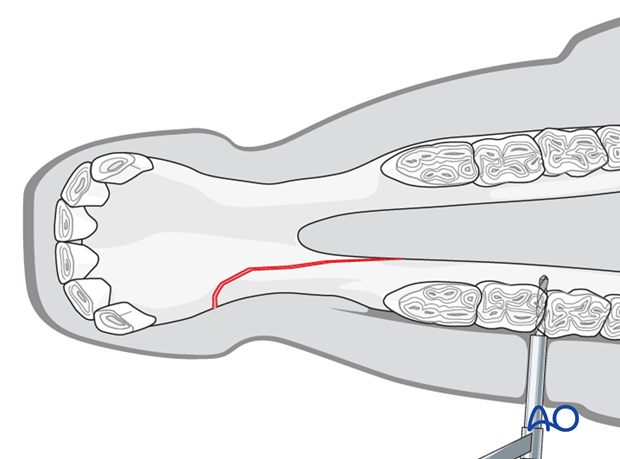 wire fixation