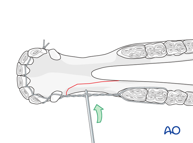 wire fixation