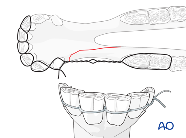 mandible horizontal ramus interdental space unilateral