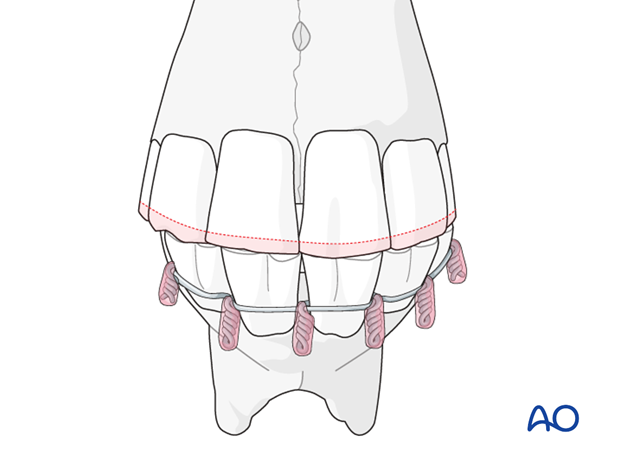 wire fixation