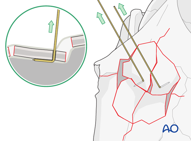 plate fixation